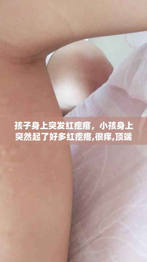 孩子身上突发红疙瘩,小孩身上突然起了好多红疙瘩,很痒,顶端硬的